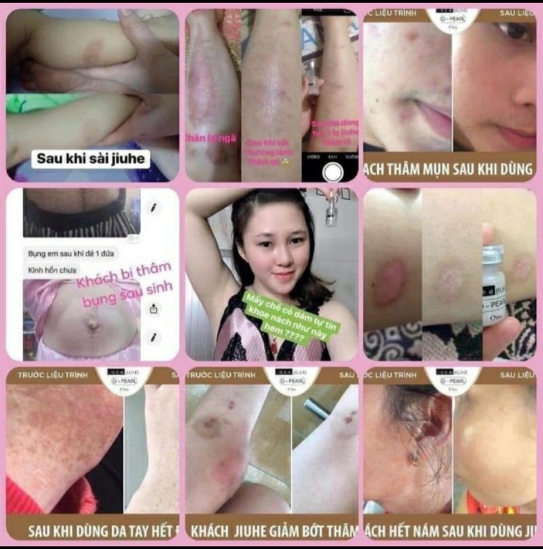 Serum Jiuhe mờ thâm nám sạch mụn 5ml
