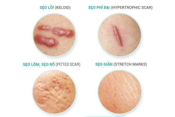 Kem Mờ Sẹo Nga Klirvin 25g