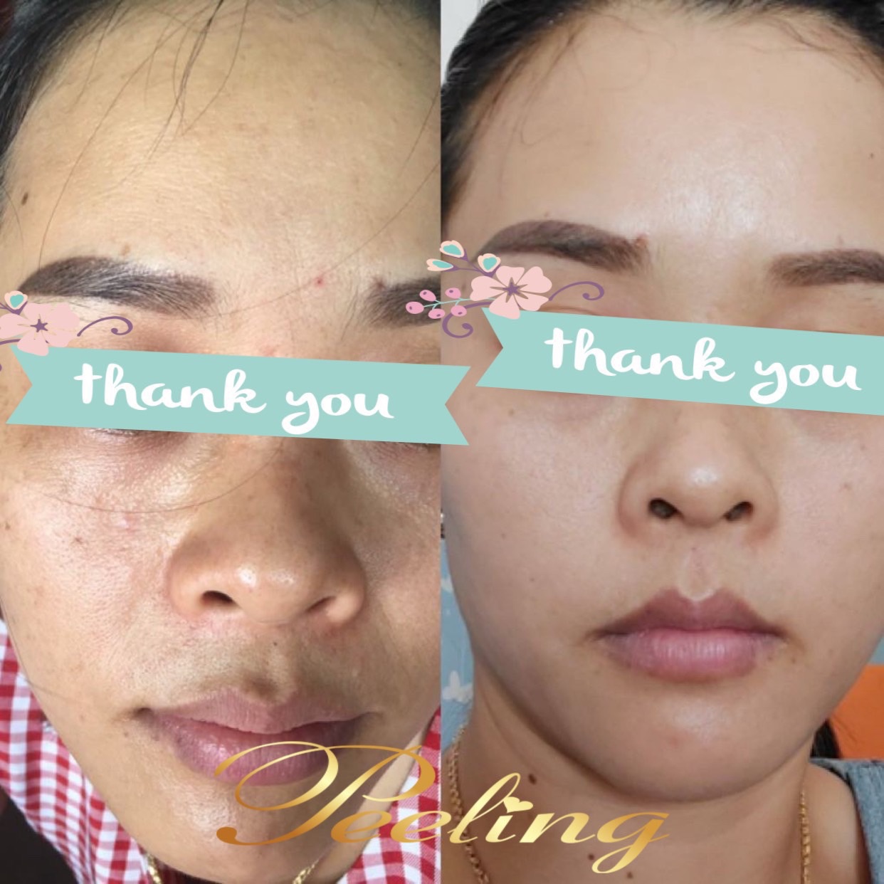 [HCM]kem Peeling Tái tạo da