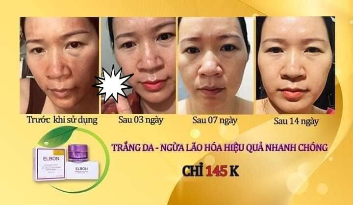 KEM DƯỠNG TRẮNG DA- NGỪA LÃO HÓA