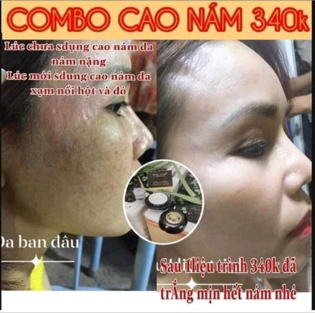 Combo Cao Nám Balla Luta và Serum Juihe