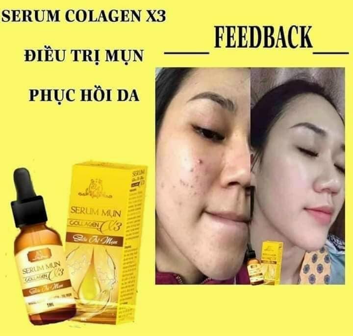 SERUM COLLAGEN X3 VUA TRỊ MỤN THÂM NÁM