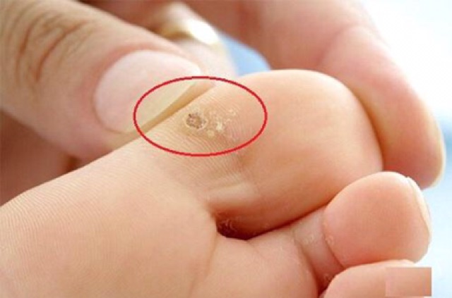 [HCM]Gel Tẩy Mụn Thịt Mụn Cóc  Mục Ruồi