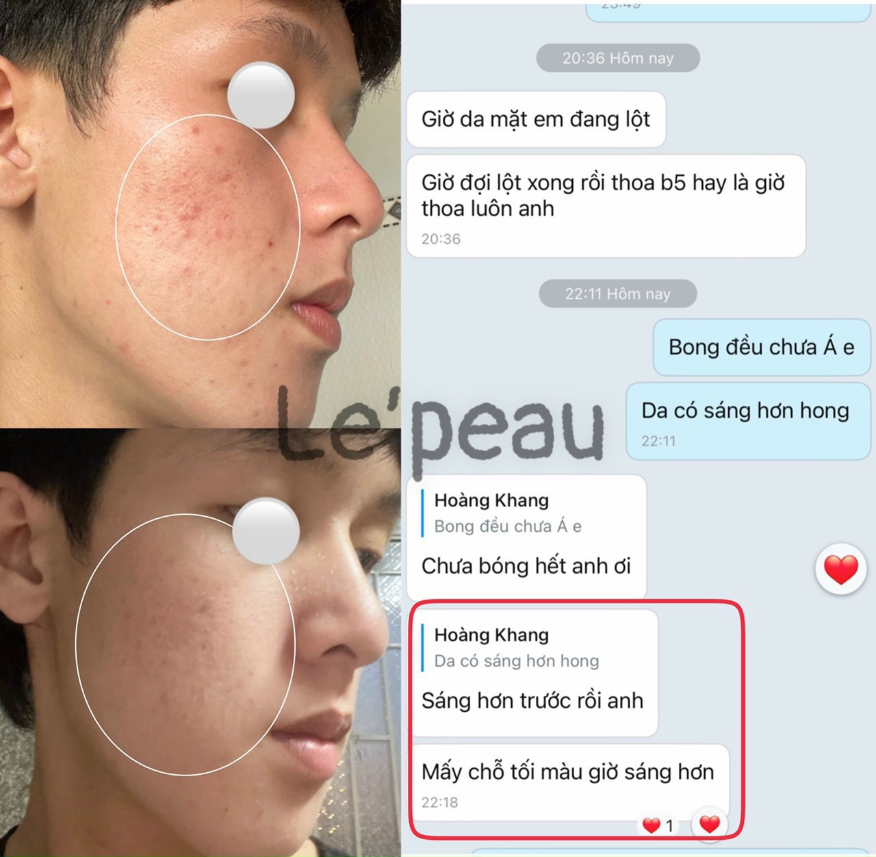LE’PEAU - Peel da Vi Tảo Retinol [Lepeau tái tạo da sinh học, tặng kèm serum B5 phục hồi da]