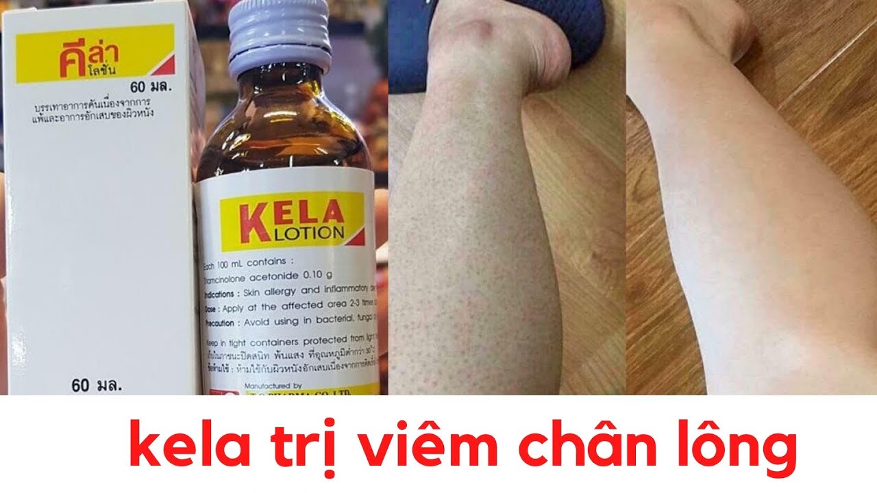 Kela Lotion viêm lỗ chân lông Thái Lan