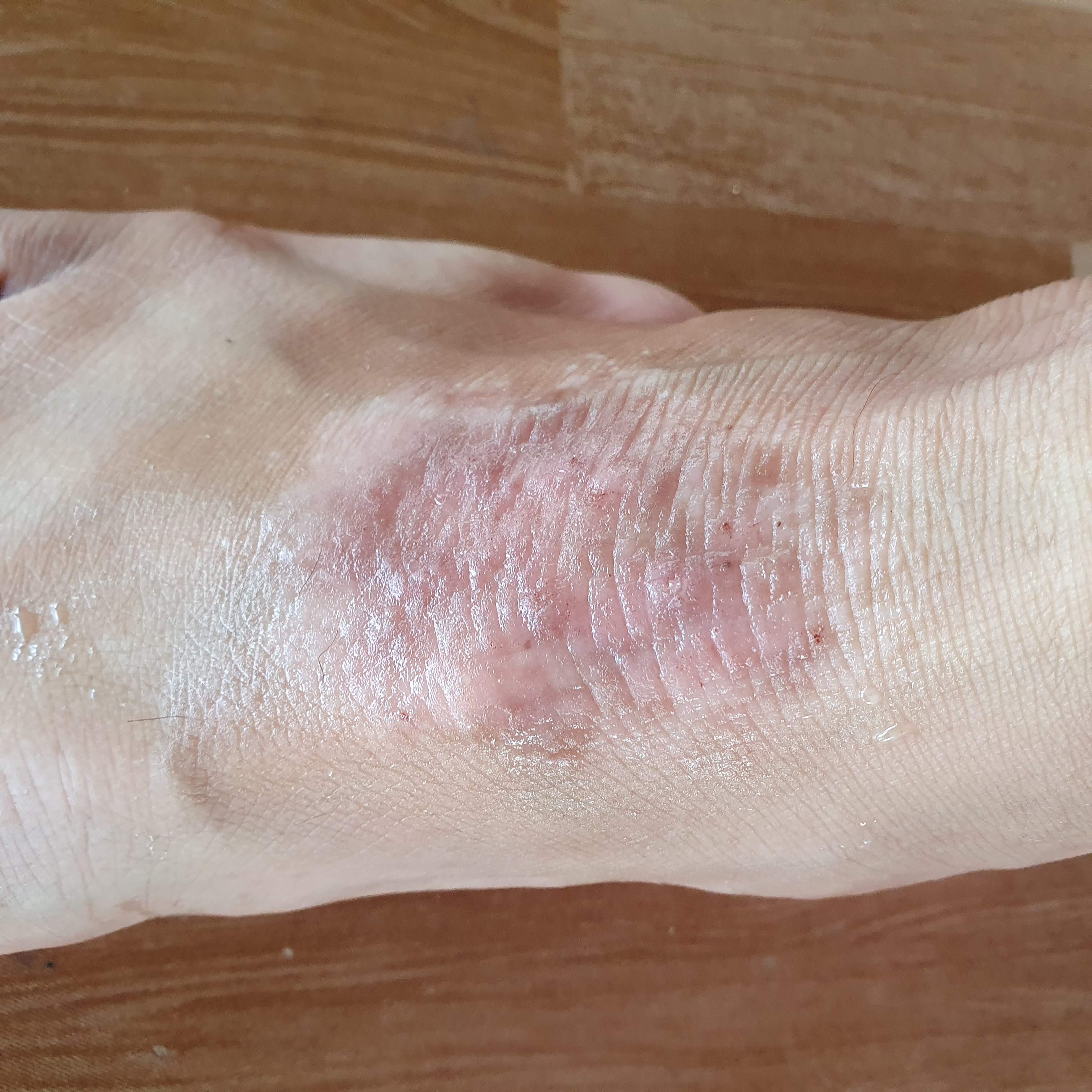 Kem bôi da Viêm da, vẩy nến, á sừng, hắc lào, nấm da