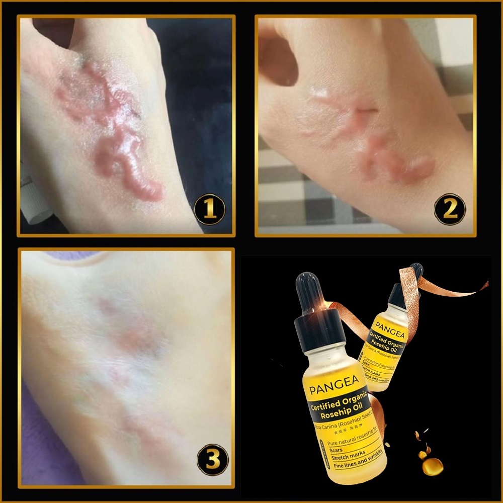 [HCM]Serum PANGEA - Xóa Sẹo Chuyên Sâu 20ml