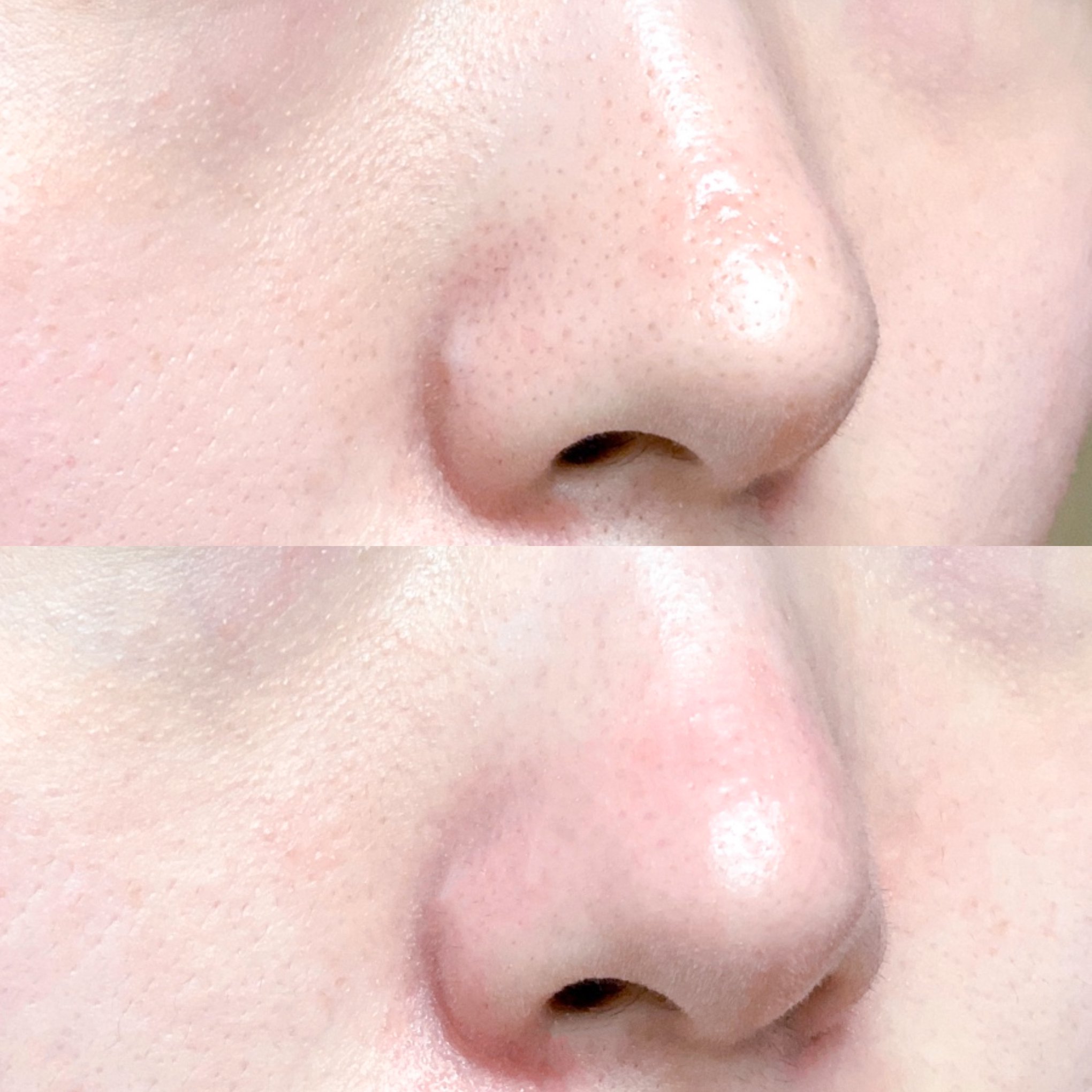 THANH LĂN GIẢM MỤN ĐẦU ĐEN [So’Natural Red Peel Clear Stick]