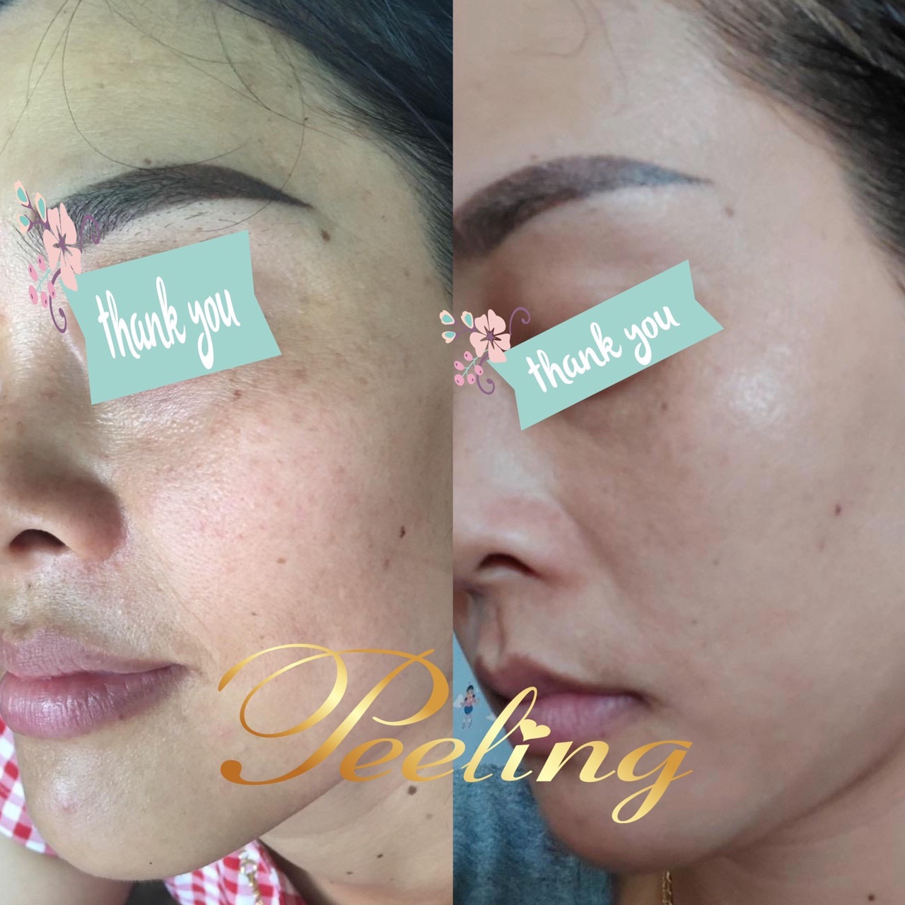 [HCM]kem Peeling Tái tạo da