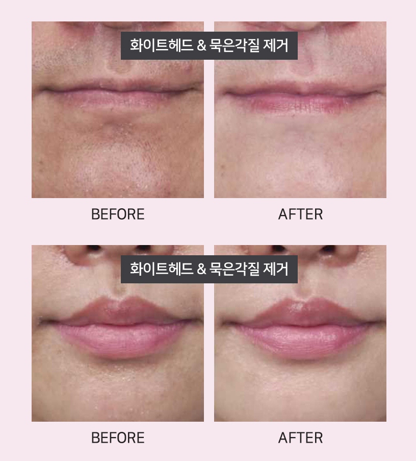 Tẩy da chết Neogen Pore Tight Peeling Mousse