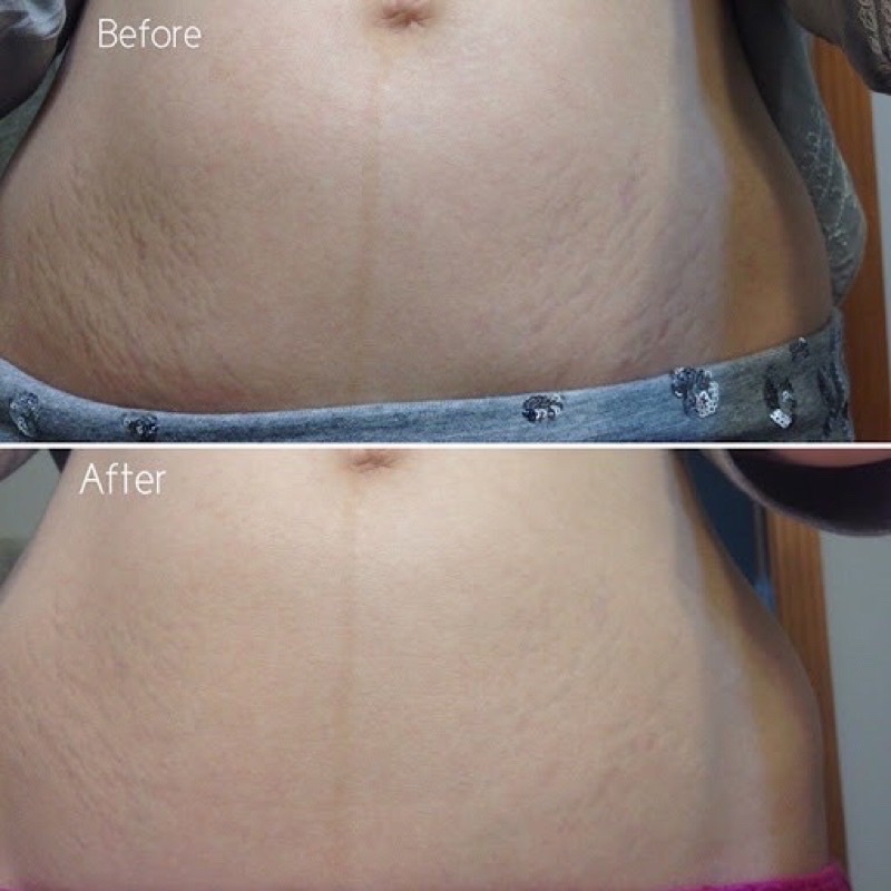 [HCM]Kem Rạn Da Stretcheal