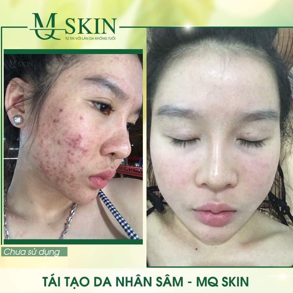 SERUM TÁI TẠO DA NHÂN SÂM MQ SKIN [ xóa mụn nám tàn nhang sẹo rổ ] (80ml)