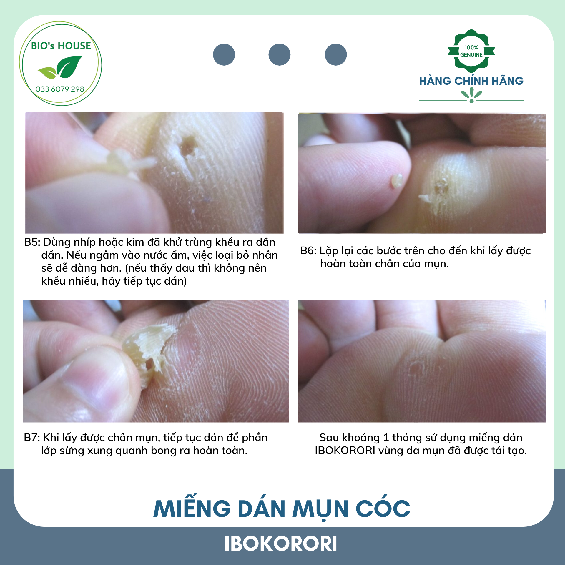 Miếng dán mụn cóc IBOKORORI 12 miếng (Nhật Bản)