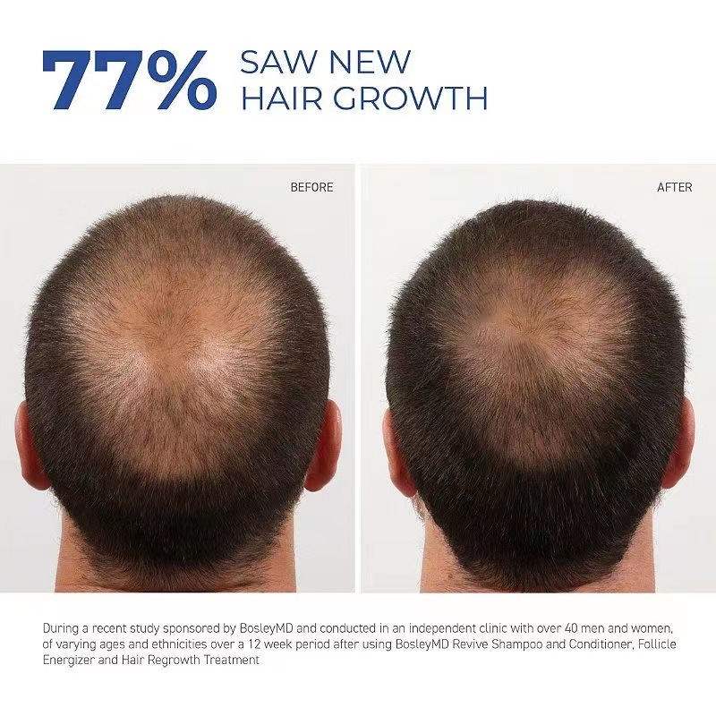 Minoxidil Kirkland 5% Minoxidil với giọt miễn phí (60ml mỗi chai)