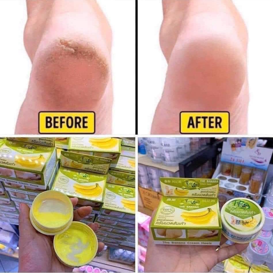 Kem chuối xóa nứt gót chân Thái Lan