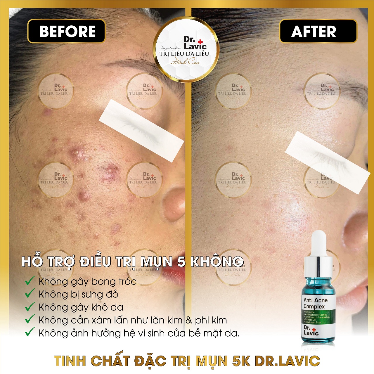 Serum Mụn 5k Dr.Lavic - Dr.Lavic Anti Acne Complex