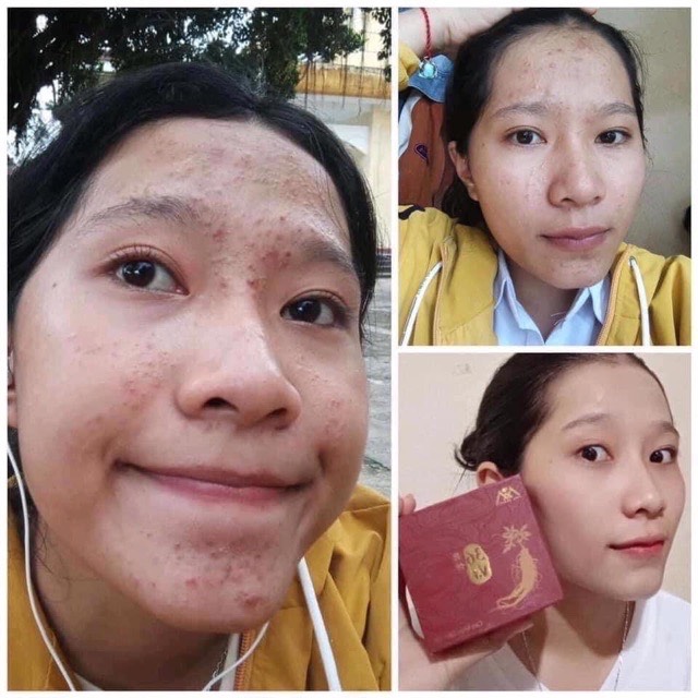 Cao Mụn Sâm Đỏ  - Loại 15g - Chính Hãng