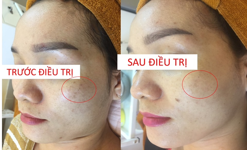 Triwhite serum FOB