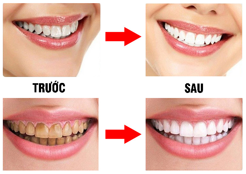 Bột than tre hoạt tính làm trắng răng