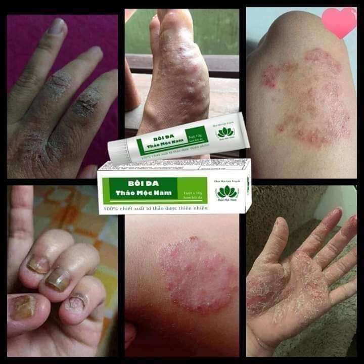 [HCM]Kem bôi da Thảo Mộc Nam