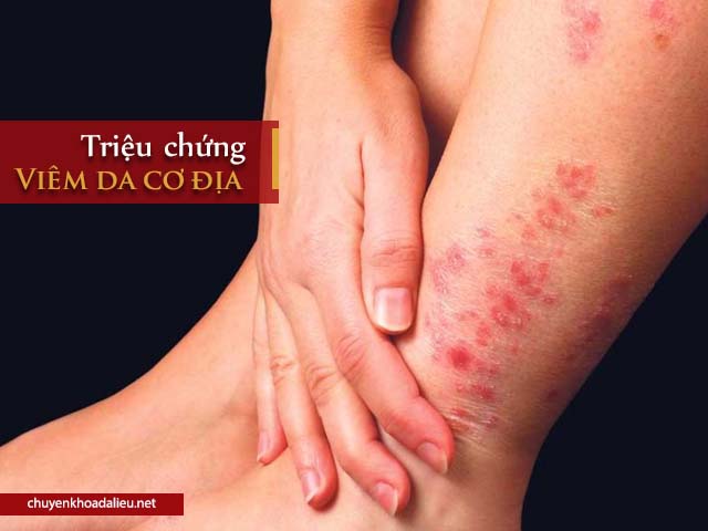 RẠN NỨT DA, VIÊM NANG LÔNG TKH ( cty Trần Kim Huyền)