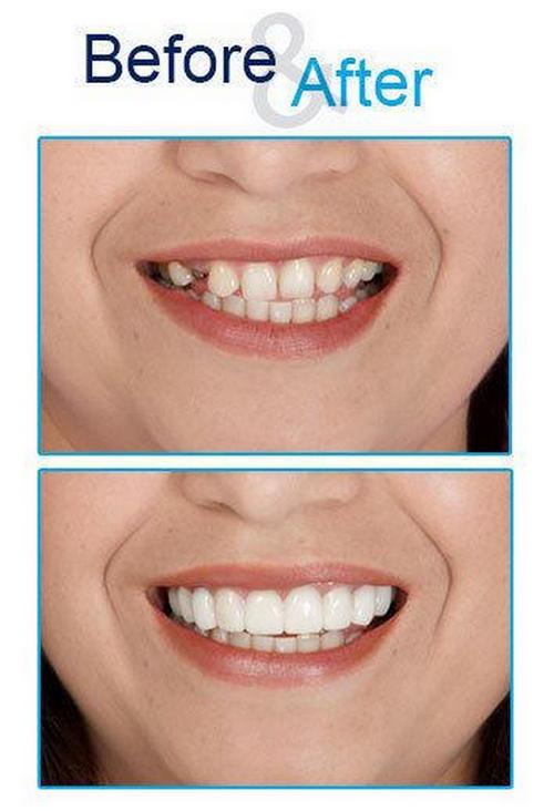 Euro Quality - Răng thẩm mỹ Snap on smile