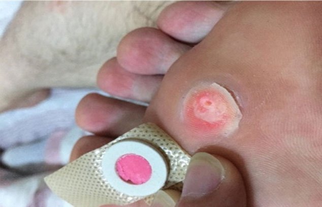 [Tặng Muối Himalaya ]Miếng dán mụn cóc mắt cá chân chai chân Plasters (18 miếng)