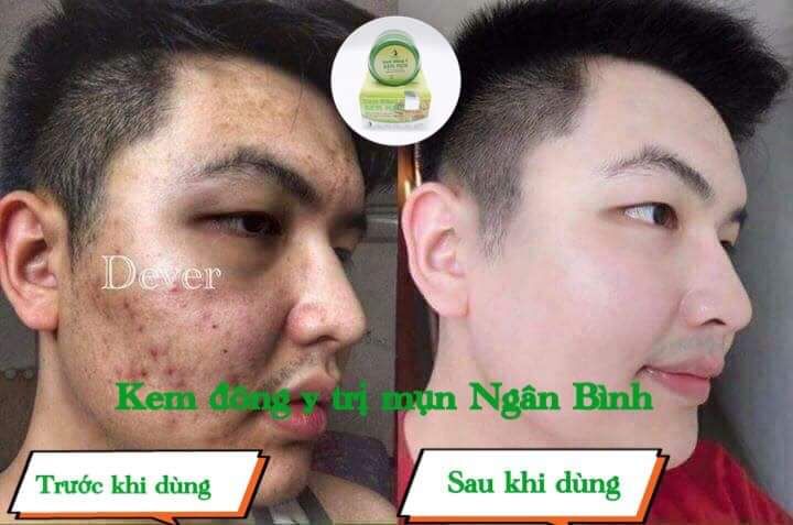 Kem mụn đông y