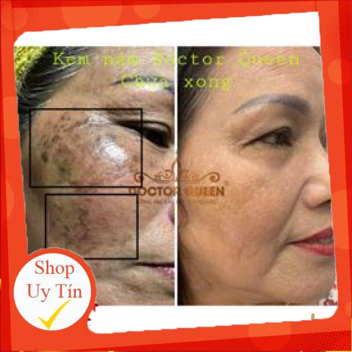 Kem Nám Doctor Queen-🔥𝐍𝐄𝐖🔥- (Ngừa Các Loại Nám,Sạm Da,Tàn Nhang,Làm Sáng Da,Đều Màu Da.,,)