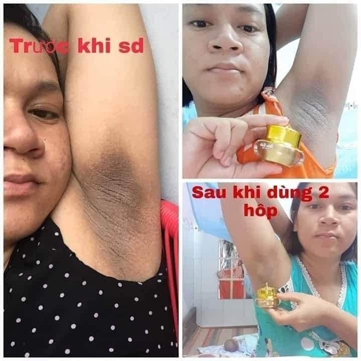 [HCM]5S BIHOLADI 5S - Siêu Dưỡng thâm chính hãng