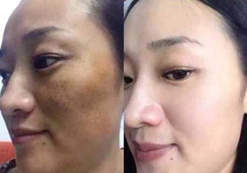 Bộ Kem Nám CLOBETAMIN G - Thái Lan