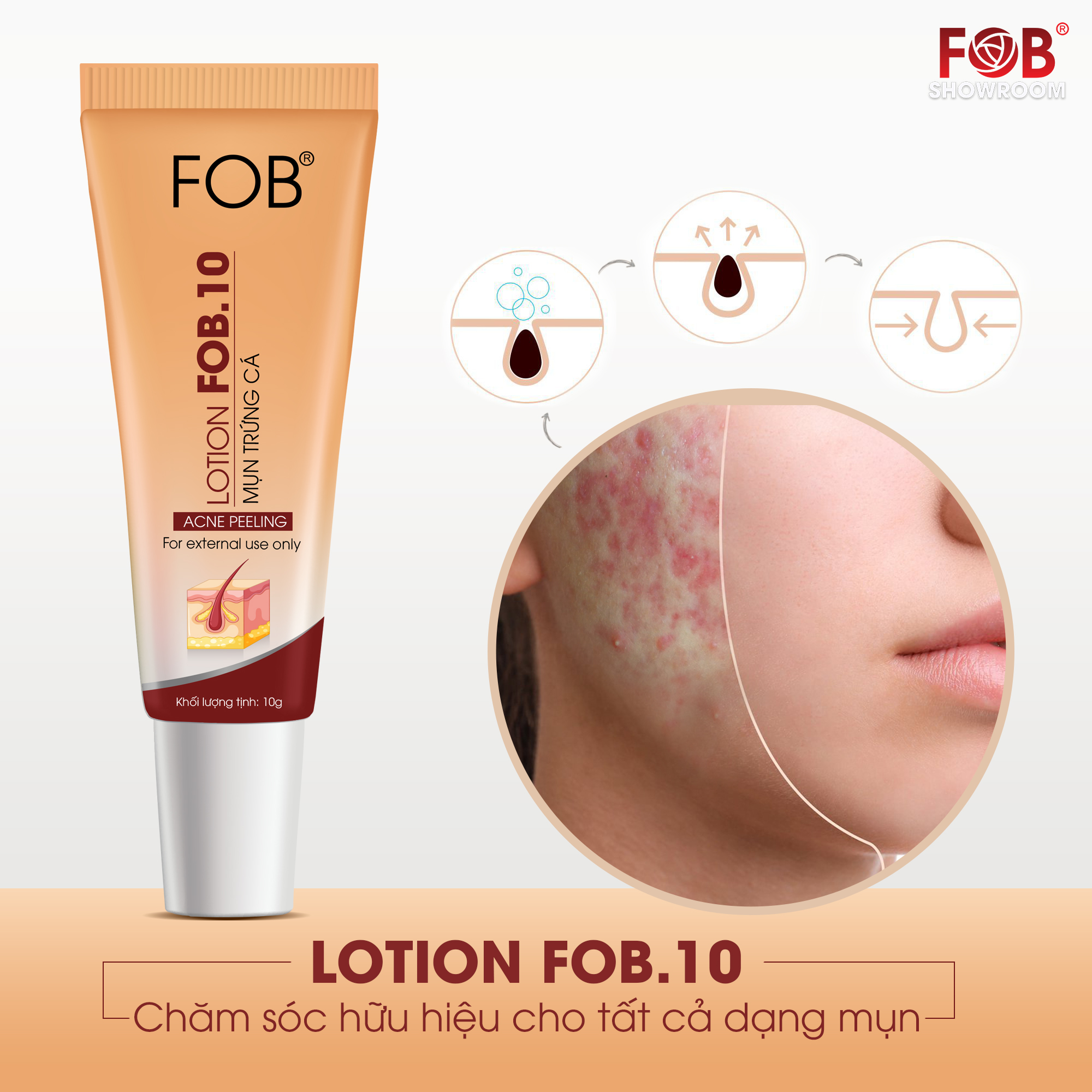 Chấm mụn FOB 10 Lotion