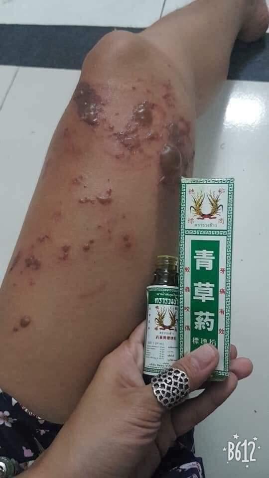 [HCM]DẦU BÔNG LÚA MINYAK THÁI LAN-THUỐC TRỊ ĐA VẾT THƯƠNG