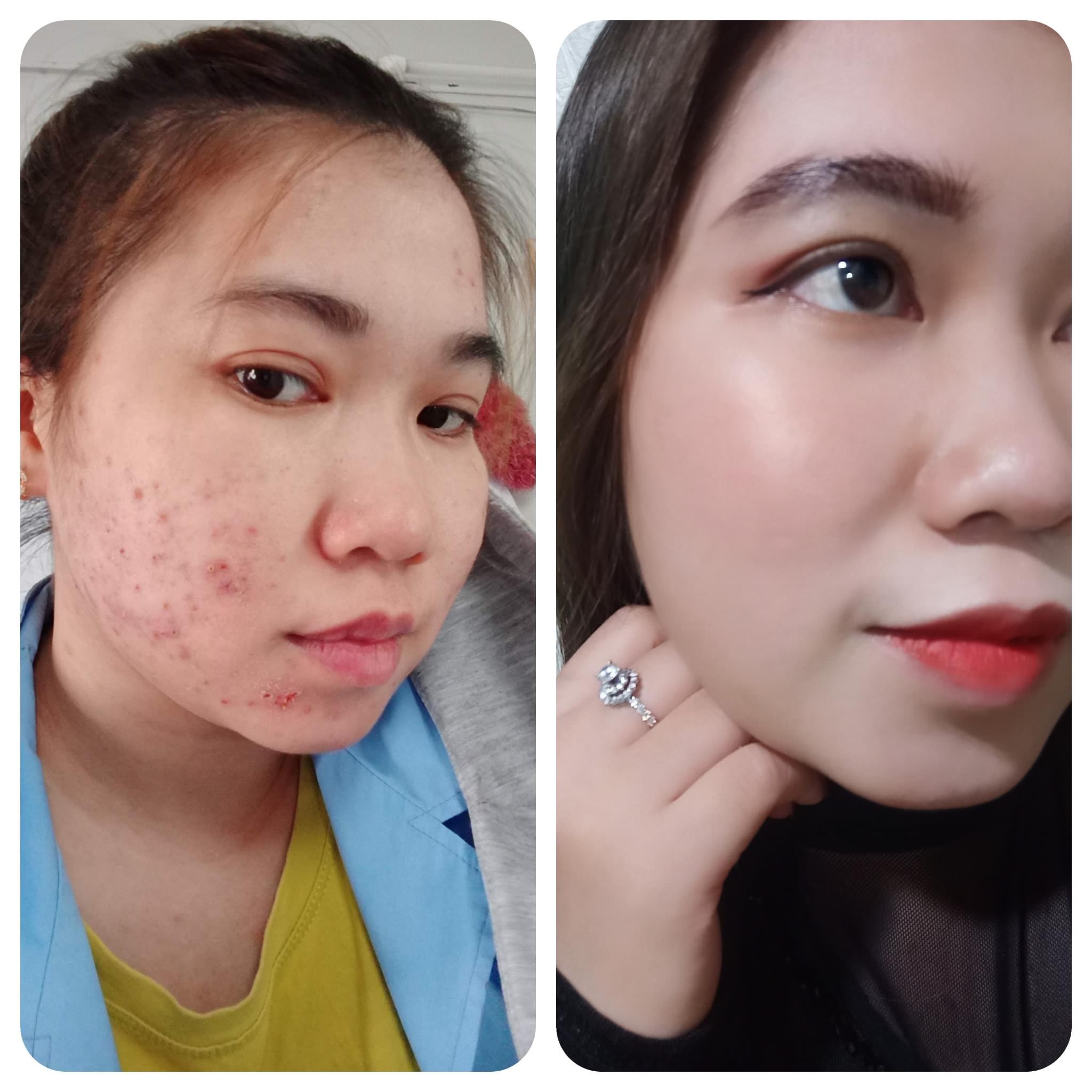 Kem mụn ngừa thâm Fairy 15gr