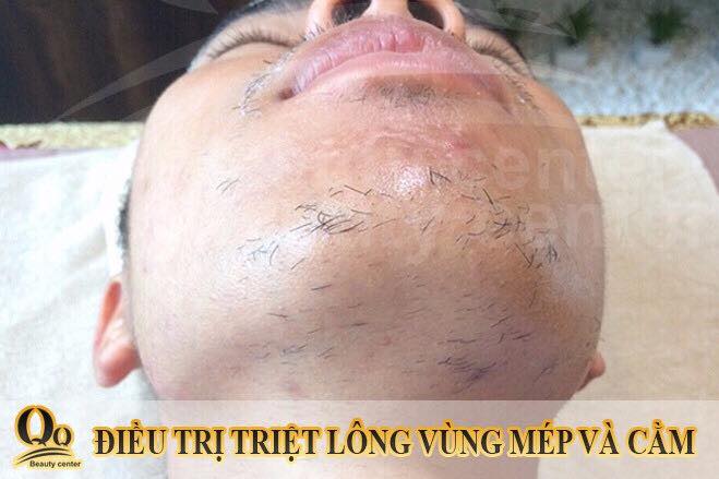 Kem Triệt Râu Triệt Lông Vĩnh viễn Radical