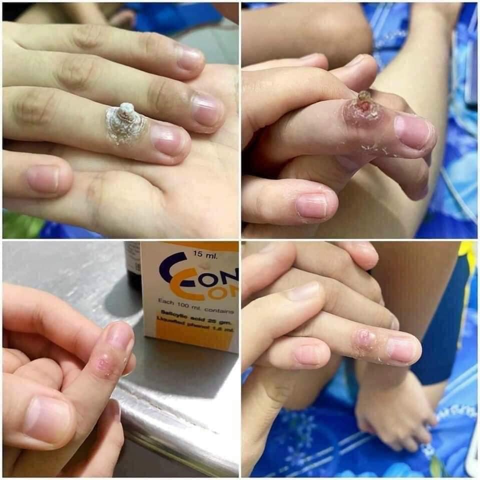 Mụn cóc, mụn cơm, nốt ruồi Của Thái