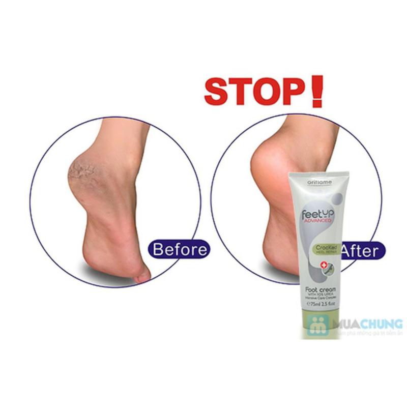 Kem dưỡng da chân và trị nứt nẻ gót chân 75ml - Feedup Comfort cao cấp