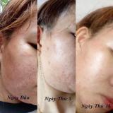 Kem Tri Mụn Sica White ( FACE ACNE CREAM  )