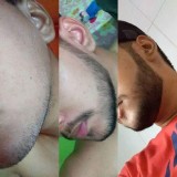 Minoxidil 5% Kirkland for Men