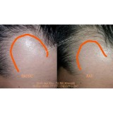 Minoxidil 5% Kirkland for Men
