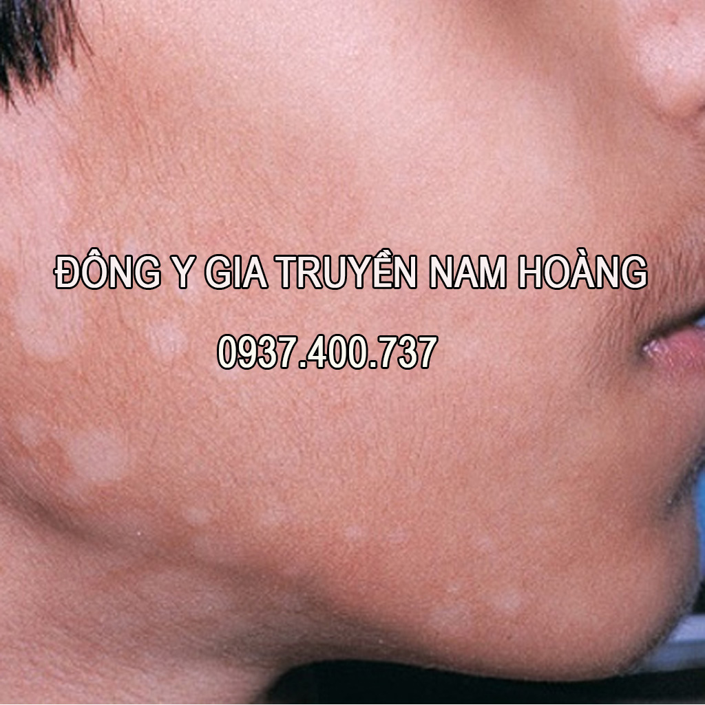 Thuốc Đặc Trị Bệnh Lang Ben Nam Hoàng