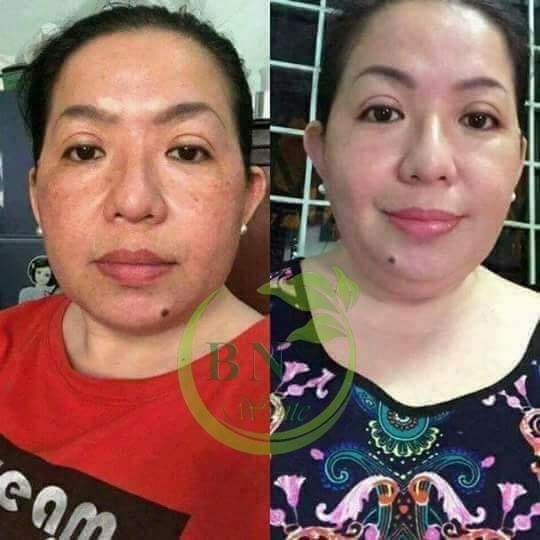 <HCM>Kem mụn trắng da ngừa nám BN WHITE
