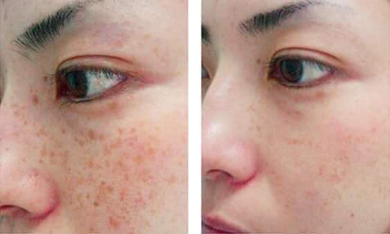 Bộ sản phẩm Nám I’m Nature