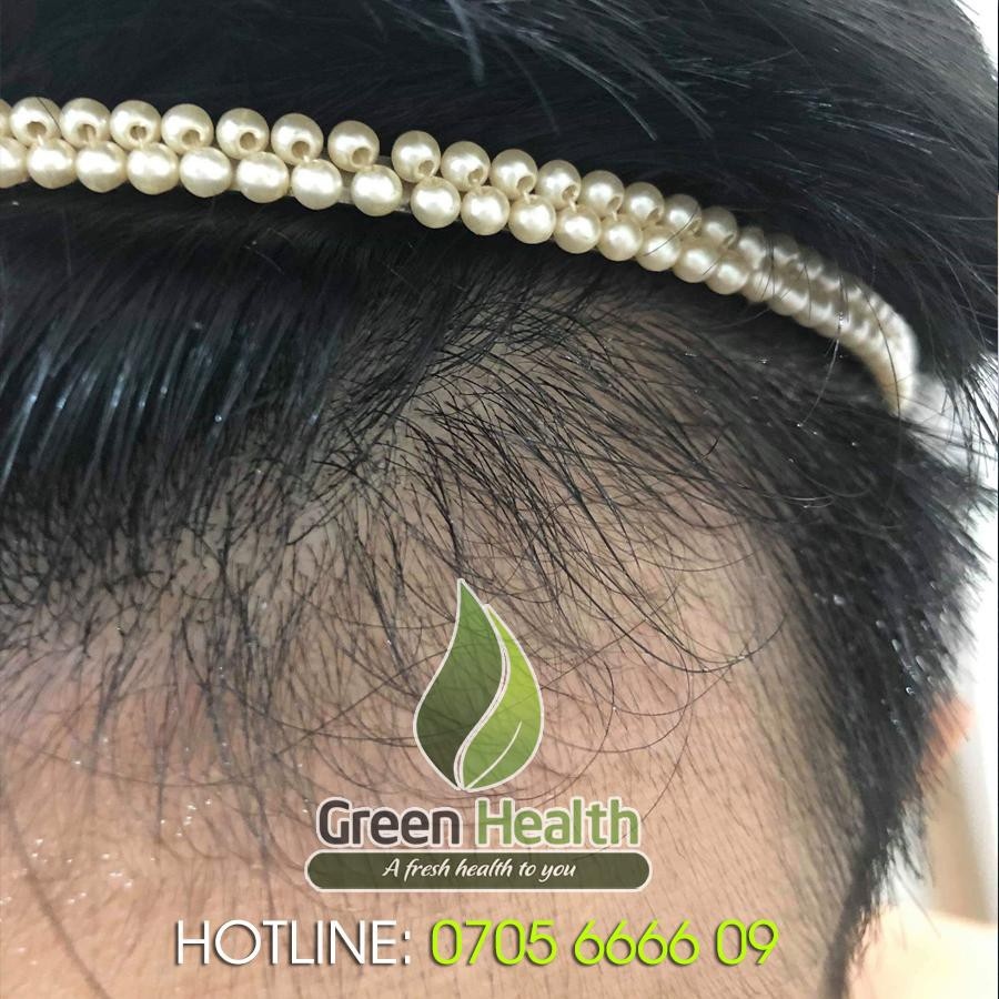 ⊙❣┇ Hộp 6 chai mọc râu tóc Minoxidil 5 dạng lỏng