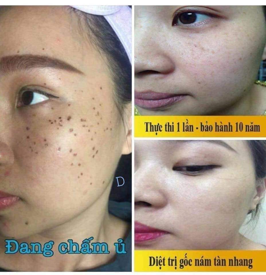 [ CHẤM NÁM ] Chấm nám tàn nhang, nám chân sâu ( ko hộp giấy)