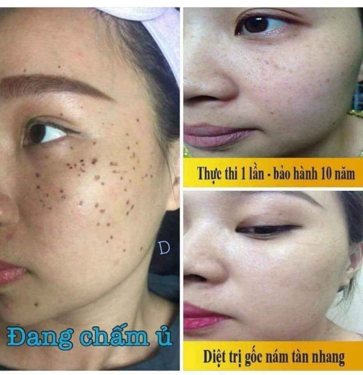 [ CHẤM na'M ] Chấm na'm tàn nhang, na'm chân sâu ( ko hộp giấy)