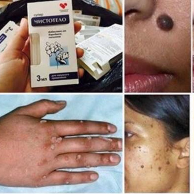 Gel Chấm Ruồi Dvelnil Nga Xóa Nốt Ruồi , Mụn Cơm , Mụn Cóc Hiệu Quả