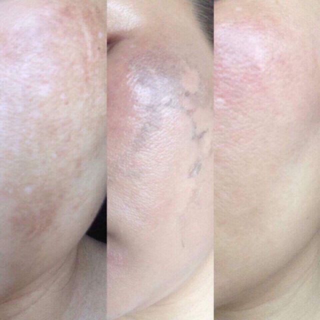 Vi Kim Tảo Biển Ultra V (1 cặp)