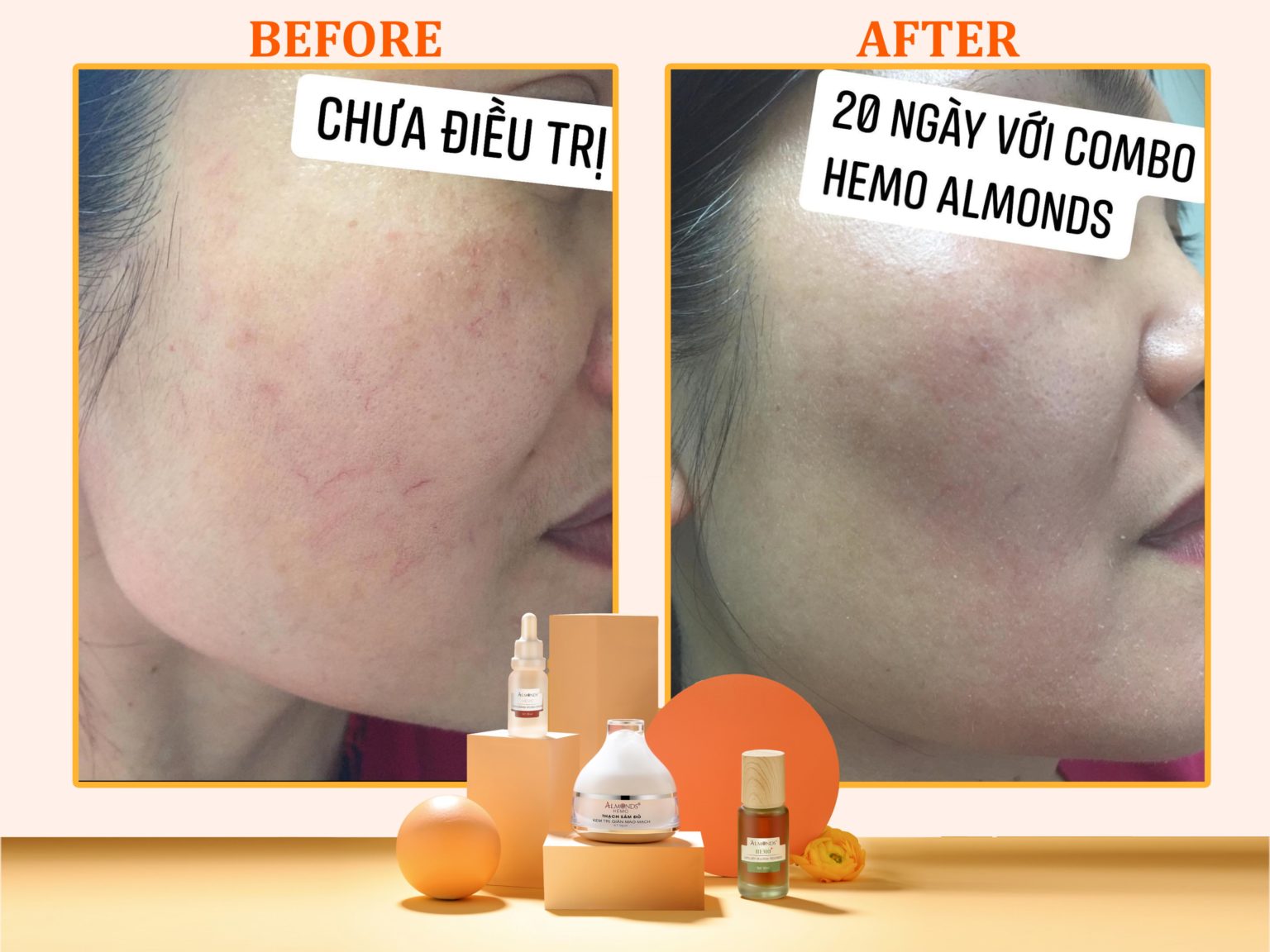 Kem  giãn mao mạch thạch sâm đỏ- HEMO ALMONDS 30g