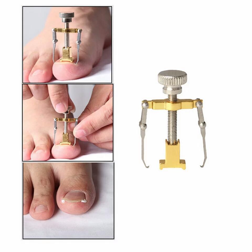 Dụng cụ chữa móng quặp móng chân chọc thịt đau đớn